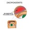 Dacryoadenitis. Inflammation of the lacrimal gland. The structure of the eye. Infographics.
