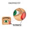 Dacryocyst. Inflammation of the lacrimal sac of the eye. The structure of the eye. Infographics. Vector illustration