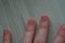 Damaged fingernails from biting due to anxiety disorders with damaged cuticles from skin picking. Dermatillomania distress and