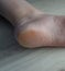 Damaged heel sole of foot with yellow cracked and damaged hard skin. Wrinkles in arch and bad look overall. Can be used for