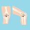 Damaged human knee joint set design vector