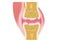 Damaged joint / crack bone and osteoarthritis 