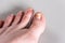 Damaged toenail on big toe on gray background. Callus on foot