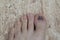 A damaged toenail on a person`s big toe