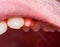 Damaged tooth enamel and chipped tooth piece. Dental restoration with dental fillings in modern dentistry, macro