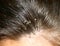 Dandruff on the hair. Hair disease seborrhea. Fatty Dandruff.