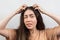 Dandruff and lice. Portrait of a young Caucasian woman, a brunette, who strongly scratches her head with her hands. White