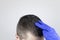 Dandruff on a man`s shoulder. Side view of a man who has more dandruff flakes on his black shirt. Scalp disease treatment concept