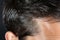 Dandruff visible in a tight frame of a mans hair strands