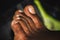 Dark skin man foot - Close-up toenail Fungus - Nail Fungus on Legs of black man. Picture of fingers on the leg. A male corn on his