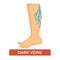 Dark varicose veins on legs symptom with feet close up