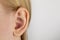 Darwin`s tubercle on the ear. The girl at the reception at the plastic surgeon, shows the auricle