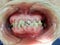 Decayed teeth check-up