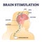 Deep brain stimulation procedure educational explanation outline diagram