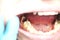 Deep caries, open canals, cleaning canals. Patient at stomatolon on admission, periodontitis treatment