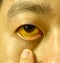 Deep jaundice of eye in Asian male patient. Yellowish discoloration of skin and sclera. Hyperbilirubinemia