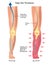 Deep vein thrombosis