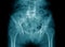Degeneration lumbosacral spine x-ray image