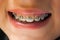 Dental appliance on the teeth of a young boy