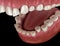 Dental attrition Bruxism resulting in loss of tooth tissue.  Medically accurate tooth