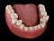 Dental attrition Bruxism resulting in loss of tooth tissue.  Medically accurate tooth illustration