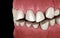 Dental attrition Bruxism resulting in loss of tooth tissue.  Medically accurate tooth illustration