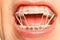 Dental braces with orthodontic latex rings on