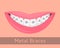 Dental braces, smiling lips in cartoon style . Smile with braces, illustration on the topic of stomatology