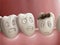 Dental caries