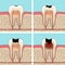 Dental caries stages.