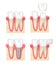Dental crown. Tooth veneer implants healthy cavity stomatology dentist vector collection