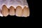Dental crowns. Close-up ceramic tooth crown