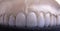 Dental crowns. Close-up ceramic tooth crown