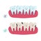 Dental dental treatment . Before and After, whitening oral care concept. Deep cleaning, clearing tooth process. illustration.