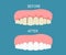 Dental dental treatment on a . Before and After, whitening oral care concept. Deep cleaning, clearing tooth process. illustration