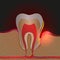 Dental disease with pain and inflammation. Medical illustration of tooth root inflammation, Gum disease, pus in the gum pocket,