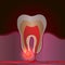 Dental disease with pain and inflammation. Medical illustration of tooth root inflammation, tooth root cyst, pulpitis