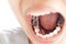Dental fillings and dental caries