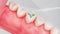 Dental fillings procedure 3d animation. Ceramic dental fillings, Medically accurate 3d animation