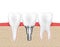 Dental human implant