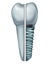 Dental Implant