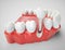 Dental implant - 3d rendering