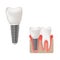 Dental implant and healthy teeth scientific modern design, realistic vector