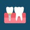 A dental implant and a normal tooth. Flat vector illustration isolated