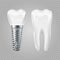 Dental implant. Realistic healthy tooth and implant. Vector dental surgery elements