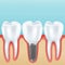 Dental implant realistic illustration