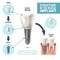 Dental Implant Structure Medical Infographic Poster