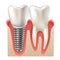 Dental Implant Tooth Set Closeup Model