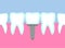 Dental implant vector illustration. Metal or titanium tooth pin installation.