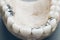 Dental implantation jaw ceramic metal denture
